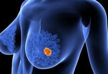 ¿Los implantes mamarios afectan la detección de cáncer de mama en las mujeres?